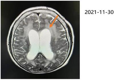 A case study of repetitive transcranial magnetic stimulation for cryptococcal meningitis combined with cognitive impairment